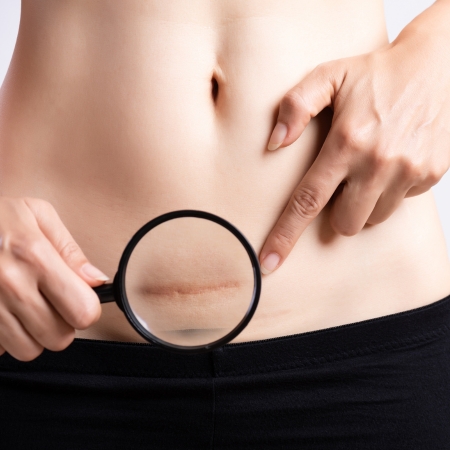 A close-up of a person’s lower abdomen shows a healing C-section scar magnified with a handheld magnifying glass, while they point to the scar.